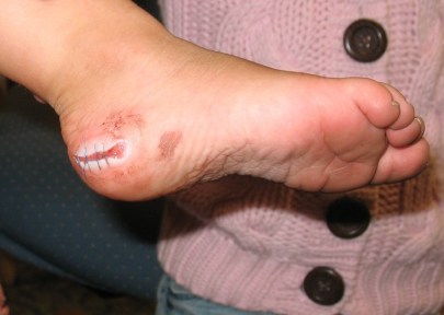 Claires first (of probably many) stitches