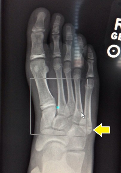 foot_xray