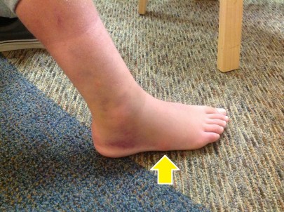 swollen_sprain